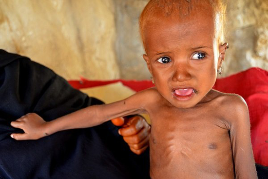 مرگ کودک یمنی در محاصره ائتلاف سعودی