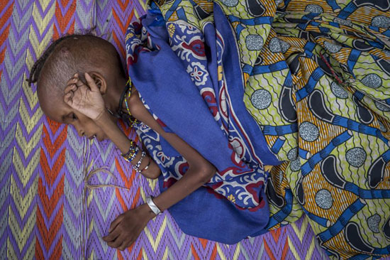 تصاویری دردناک از کودکان گرسنه آفریقا