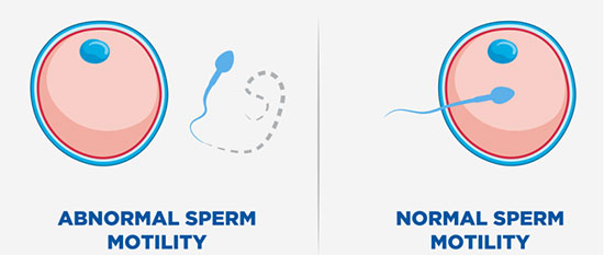 آزمایش اسپرم و تفسیر نتایج آن