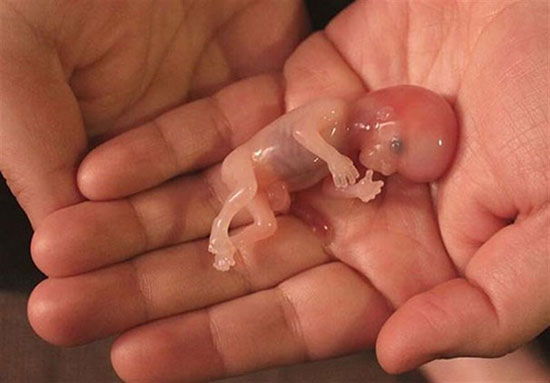 سقط عمدی جنین و پیامد‌ها و خطراتش