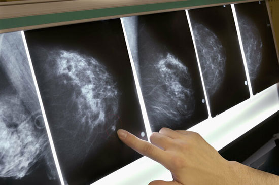 تشخیص سرطان پستان پنج سال زودتر از ابتلا!