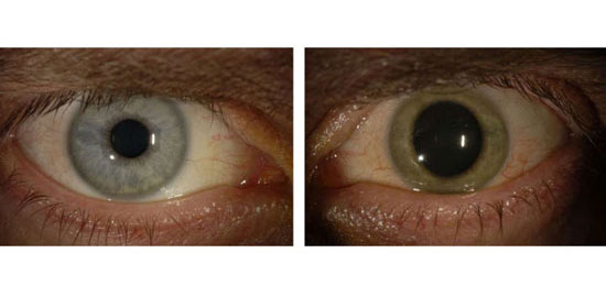 ابولا، رنگ چشم بیمار را تغییر داد +عکس