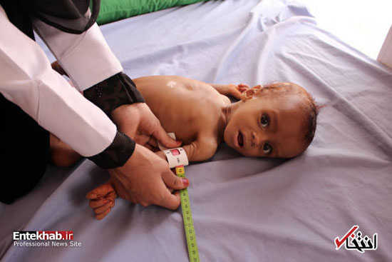 قحطی و گرسنگی وحشتناک در یمن (۱۶+)