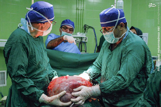 تومور 12 کیلویی در شکم زن ایرانی +عکس