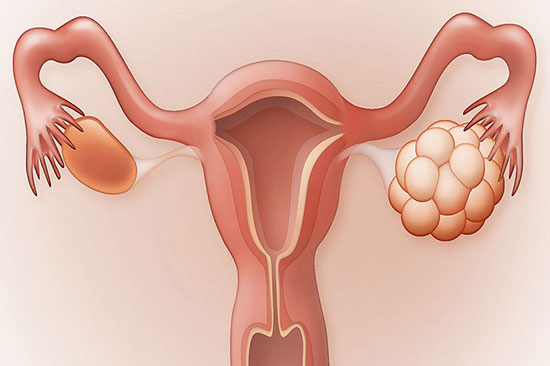 بیماری‌های شایع لگنی در زنان؛ از دیسمنوره تا آندومتریوز