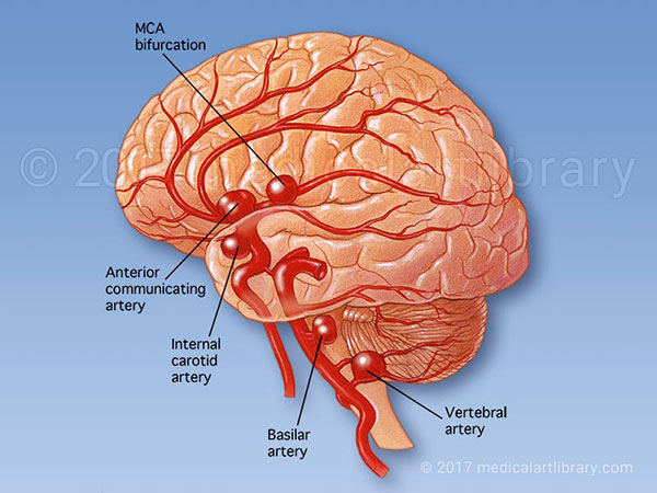 آنوریسم مغزی؛ علل و علائم و درمان