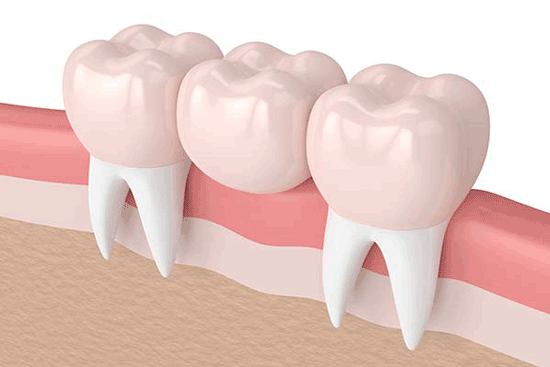 بریج دندان چیست؟ مزایا و قیمت آن