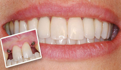 دکتر امینی - ایمپلنت جایگزینی برای دندان