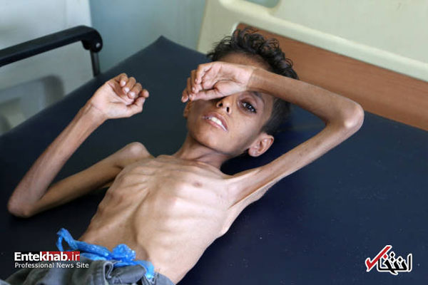 سوءتغذیه کودک ۱۰ ساله یمنی (۱۶+)