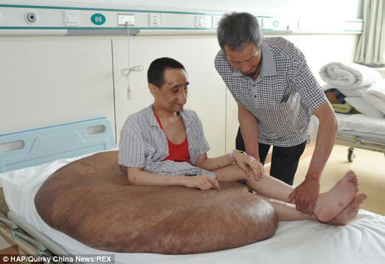 تصاویری از عمل جراحی بزرگترین تومور جهان