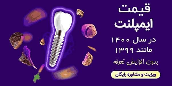 قيمت ايمپلنت - دکتر مهران امینی