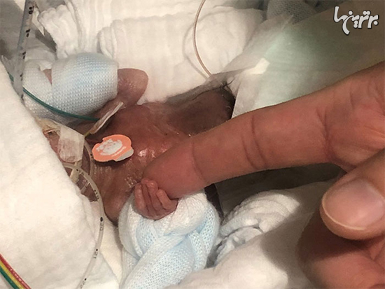کوچکترین نوزاد نارس جهان از بیمارستان مرخص شد