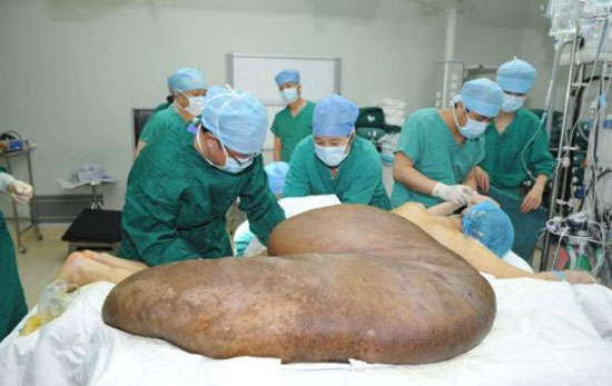 تصاویری از عمل جراحی بزرگترین تومور جهان
