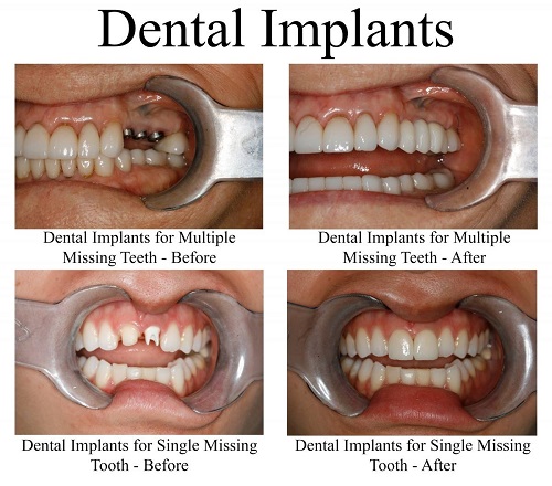 انواع ایمپلنت دندان؛ تفاوت و هزینه‌ی آن‌ها 