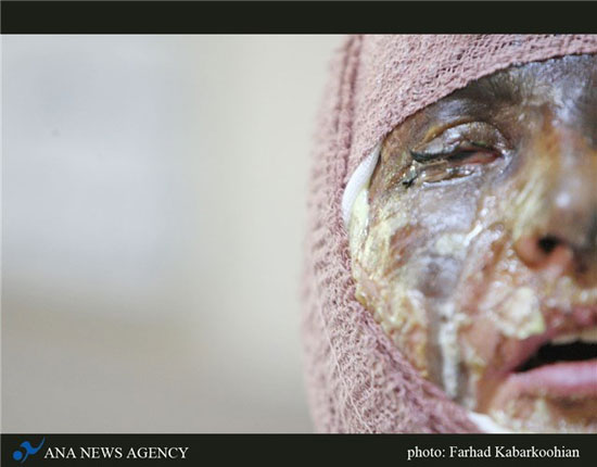 عکس: اسید زیبایی «سیما» را تباه کرد (18+)