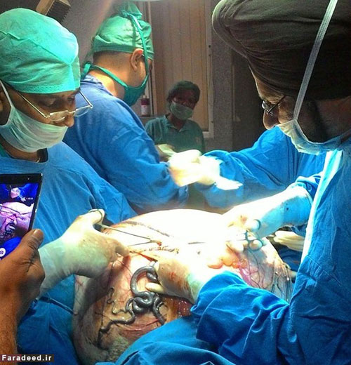 جراحی تومور 95کیلوگرمی شکم یک زن