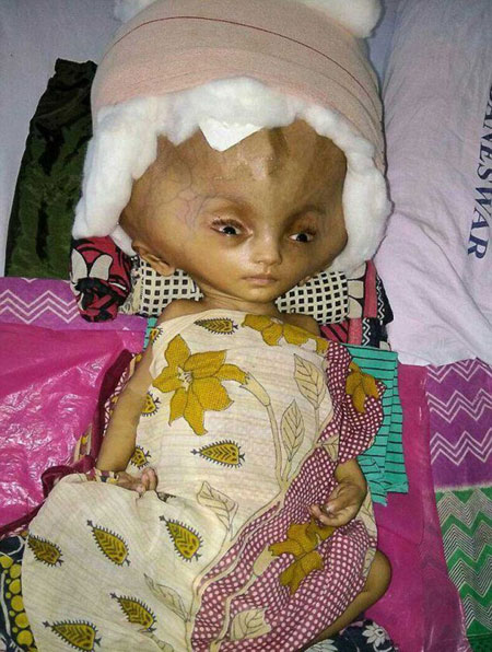 نوزاد فضایی در هند زیر تیغ جراحان این کشور رفت