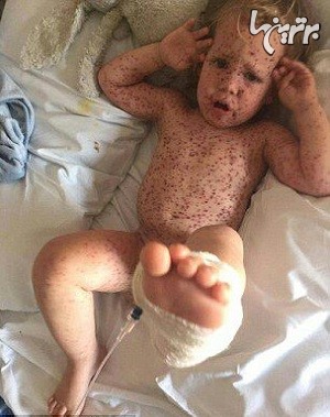 کودکی که بدترین آبله مرغان دنیا را گرفت