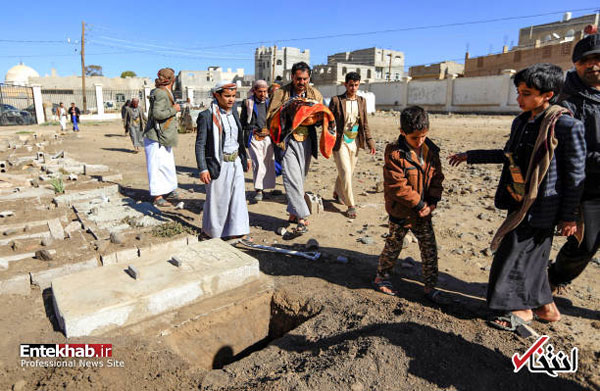 دوقلو‌های به هم چسبیده یمنی جان باختند