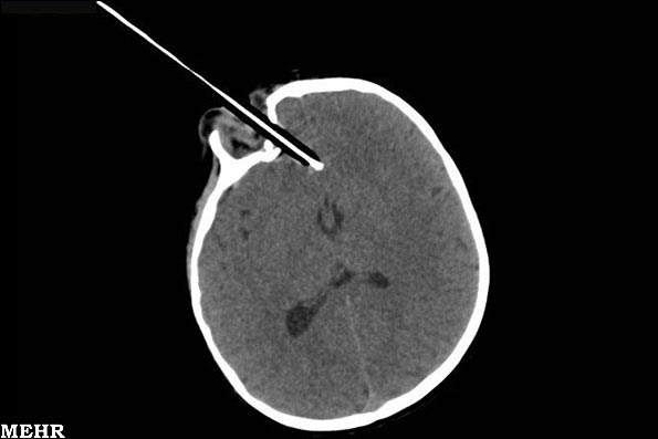 تصویر یک مداد در داخل مغز کودک 2 ساله!