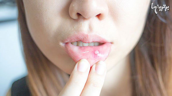چه زمانی آفت دهان خطرناک می‌شود؟
