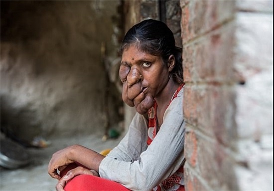 بیماری عجیب دختر جوان هندی