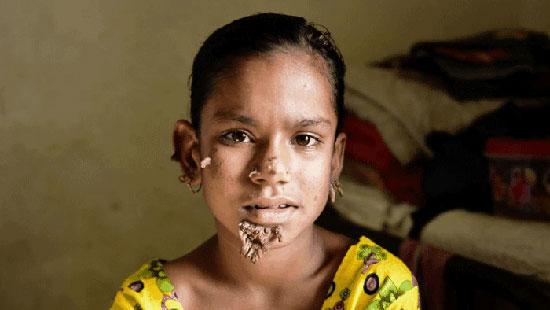دختر بنگلادشی ۱۲ ساله‌ با بیماری نادر «مرد درختی»