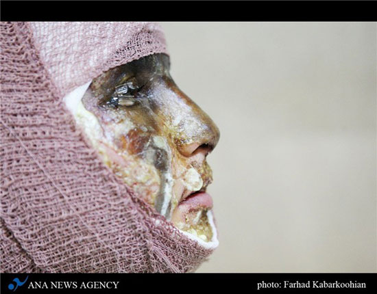 عکس: اسید زیبایی «سیما» را تباه کرد (18+)