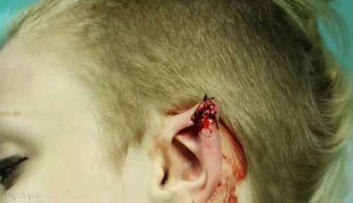 عکس: عمل جراحی زیبایی روی گوش! (14+)