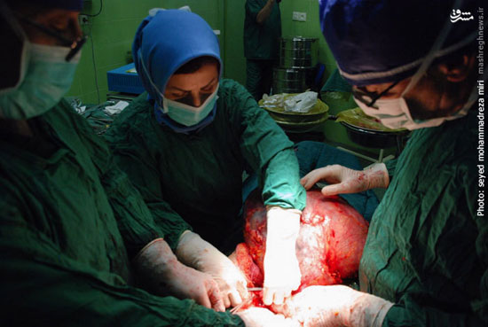تومور 12 کیلویی در شکم زن ایرانی +عکس