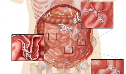 درمان چسبندگی روده | علائم و روش های تشخیص انسداد روده چیست؟
