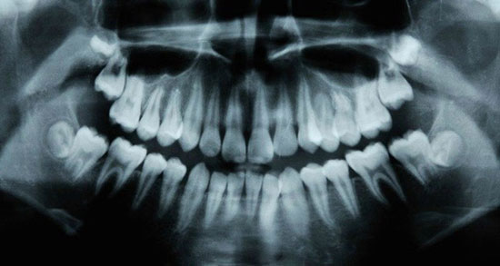 ترمیم خودکار پوسیدگی دندان با داروی ضد آلزایمر