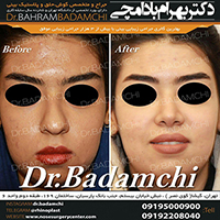 جراحی مدرن بینی توسط دکتر بهرام بادامچی