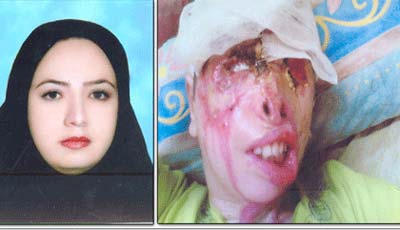 عکس مادر و دختر قربانی اسیدپاشی