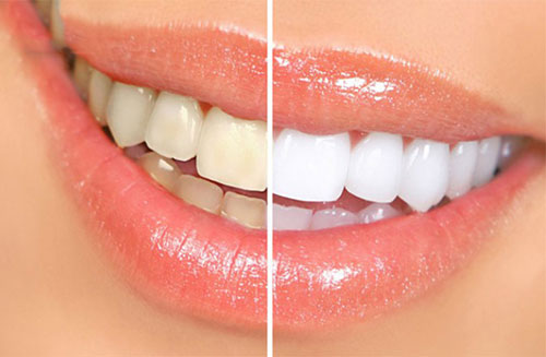 مدهای زیبایی چه بر سر دندان‌های‌تان می‌آورند؟